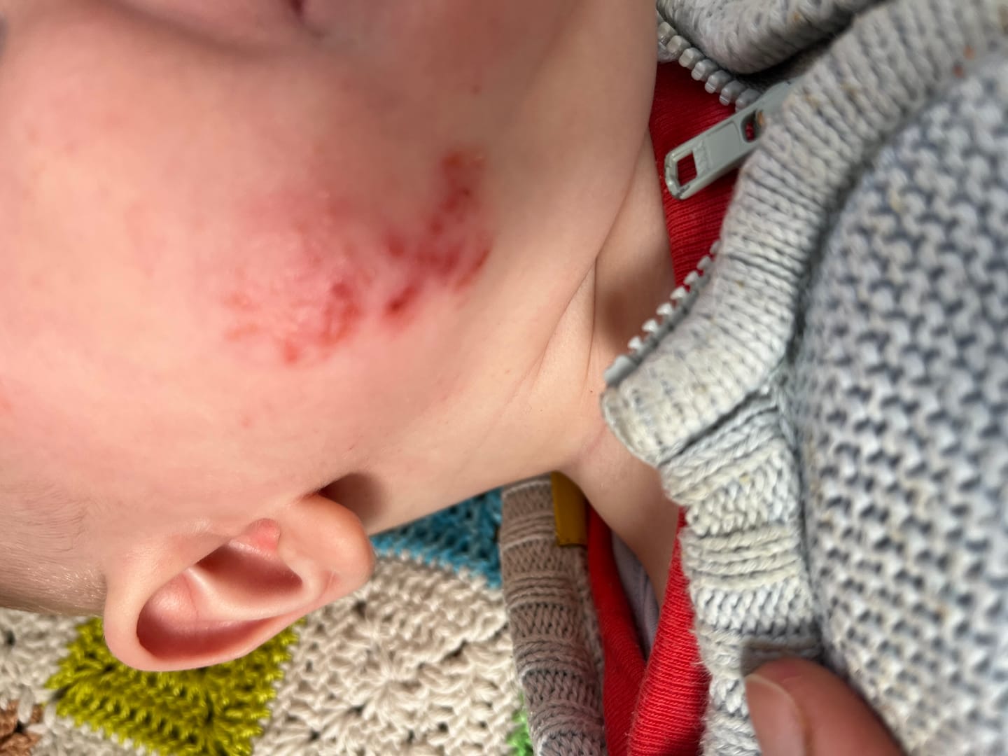 Customer photo review of Bioskin Junior Outbreak Rescue Cream