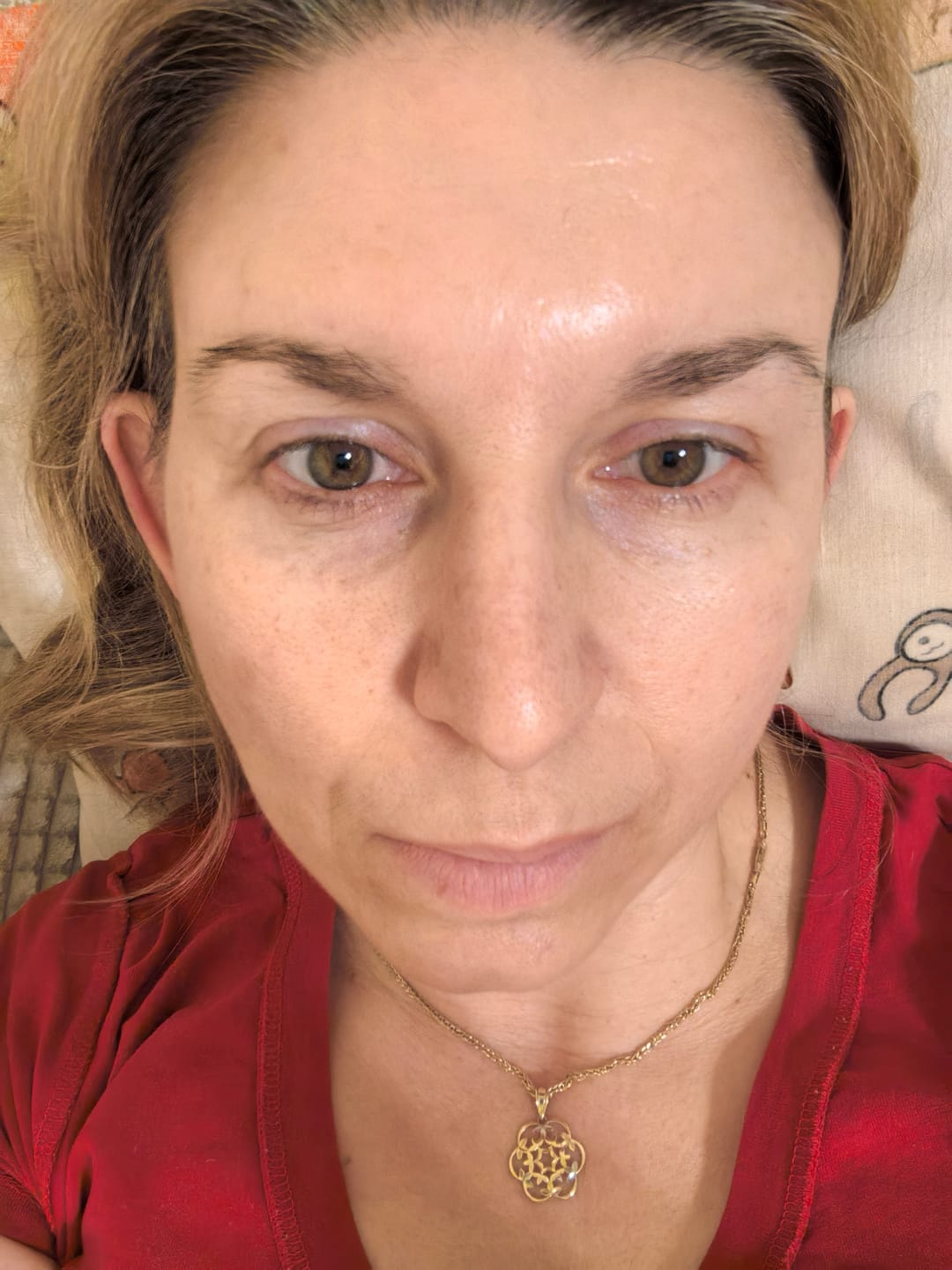 Customer photo review of Superlift пластири за бръчки