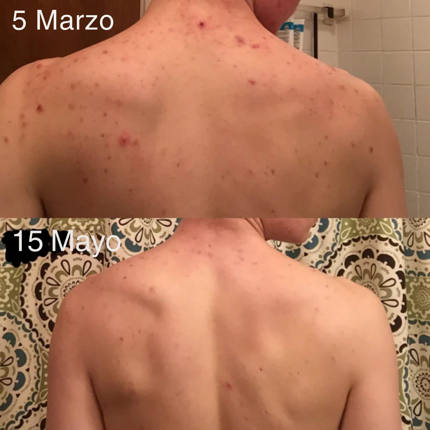 Customer photo review of Barra Anti Acne™