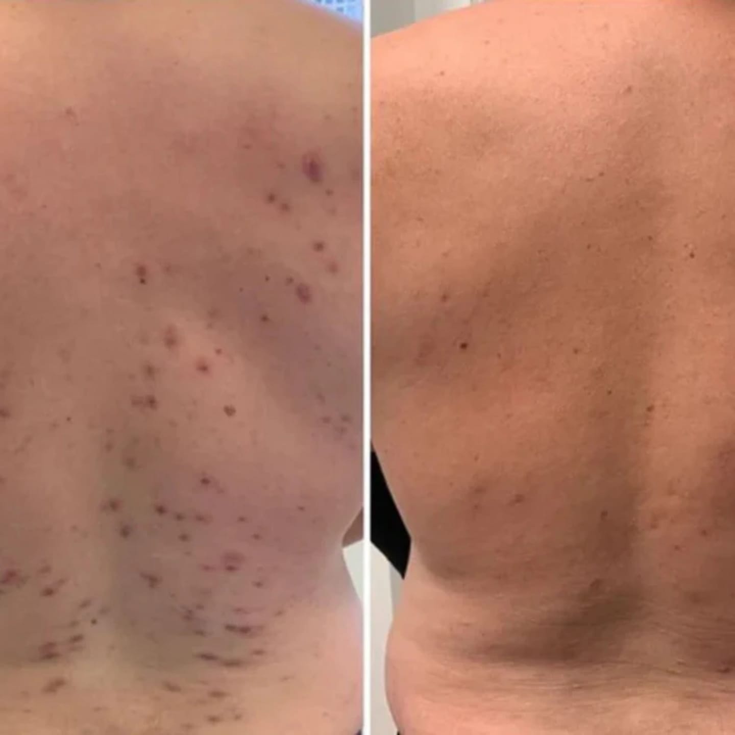 Customer photo review of Barra Anti Acne™