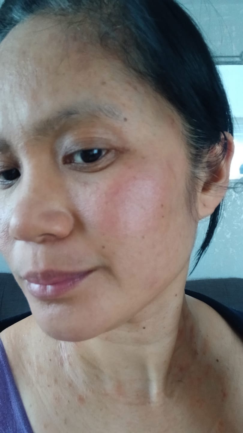 Customer photo review of Calm Skin-Relief Kit