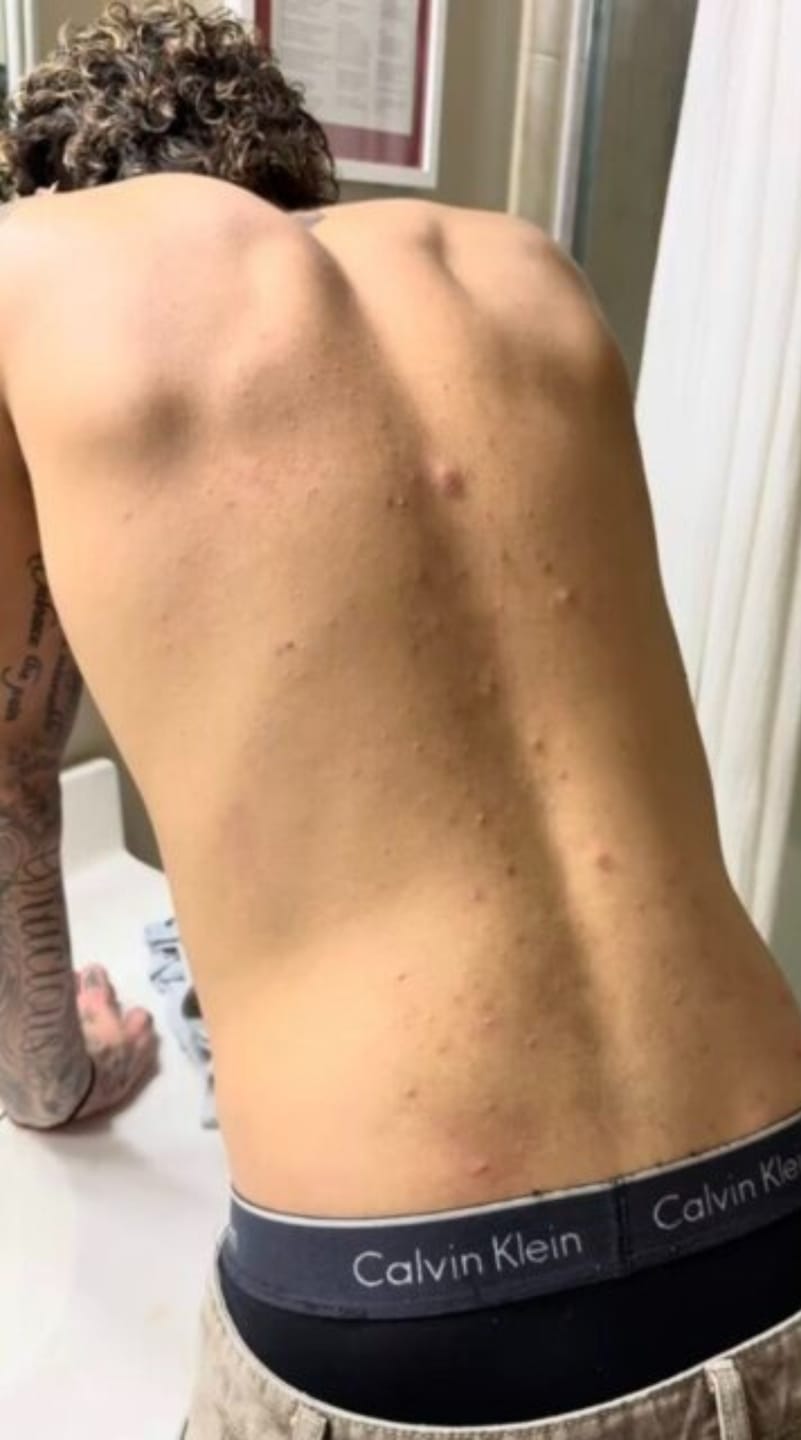 Customer photo review of Barra Anti Acne™