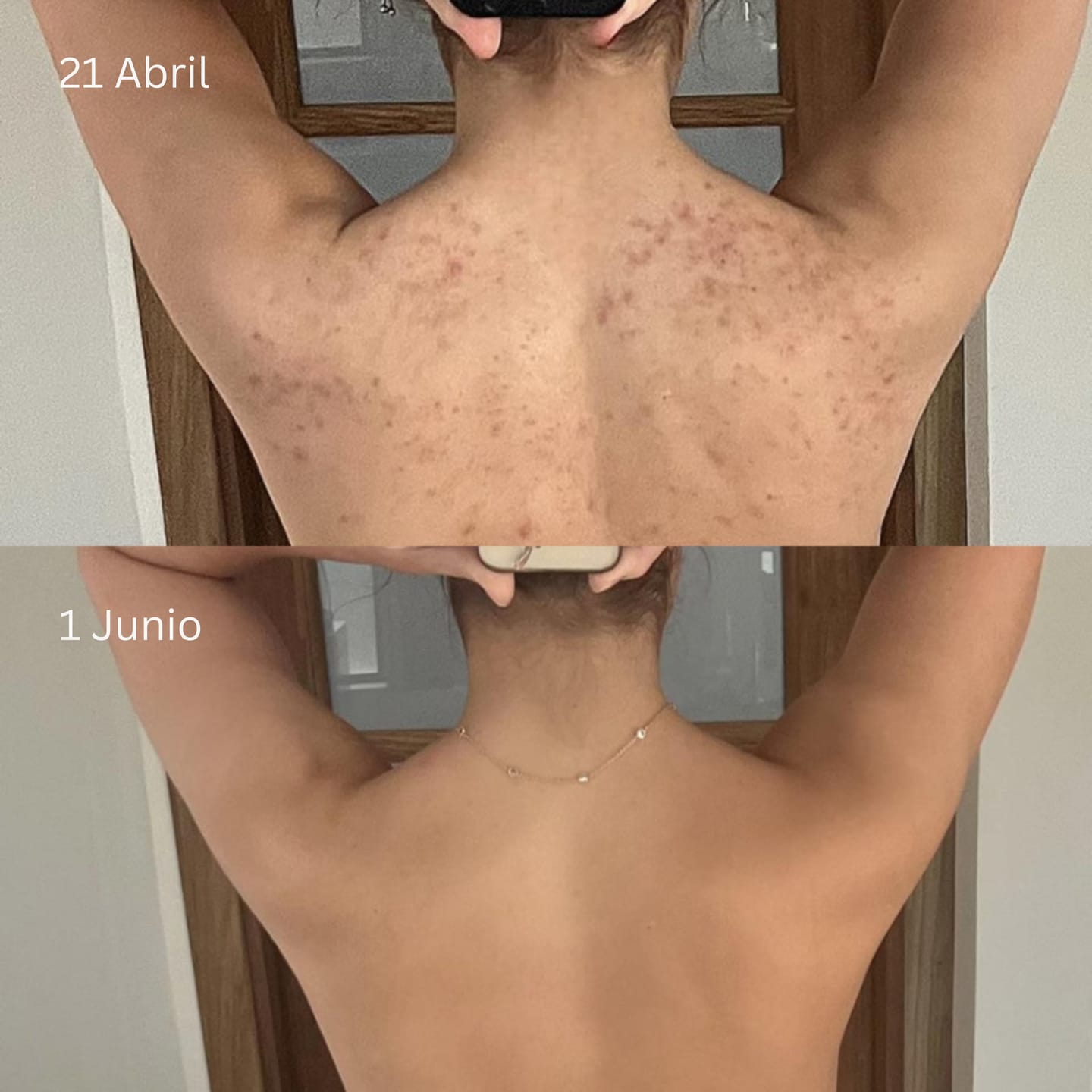 Customer photo review of Barra Anti Acne™