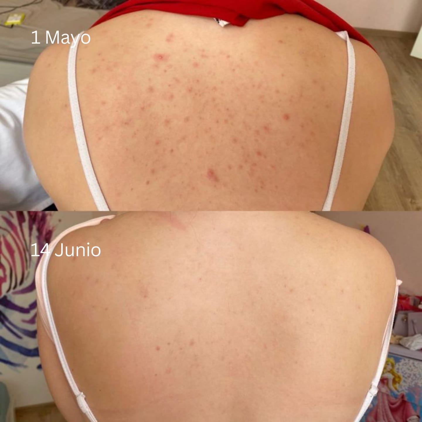 Customer photo review of Barra Anti Acne™