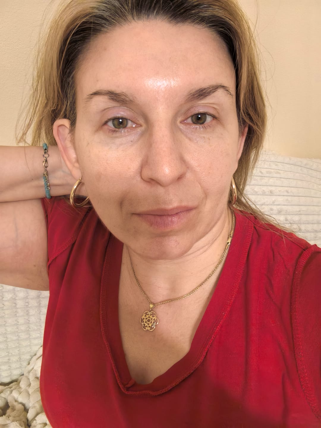 Customer photo review of Superlift пластири за бръчки