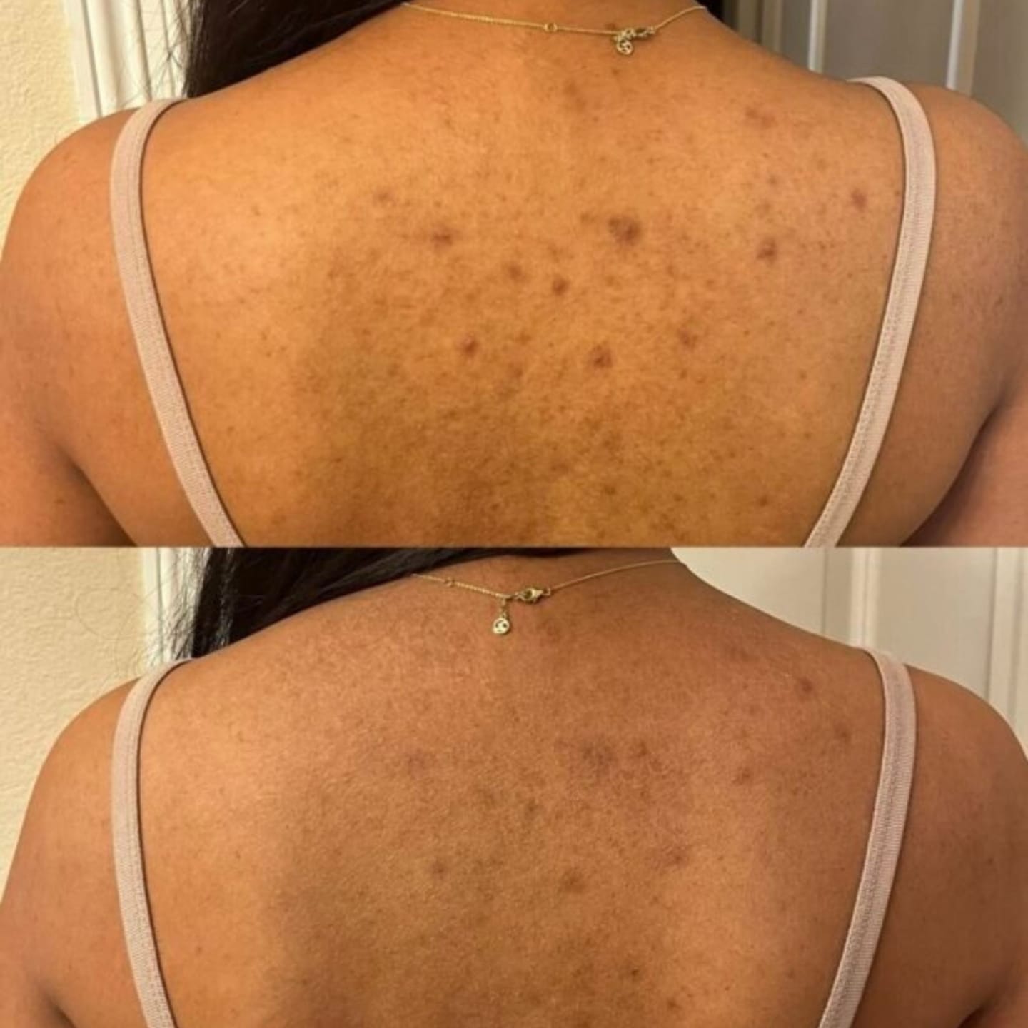 Customer photo review of Barra Anti Acne™