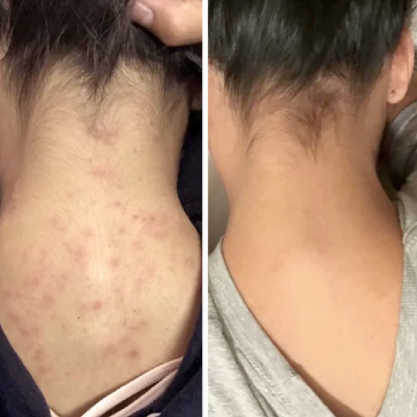 Customer photo review of Barra Anti Acne™