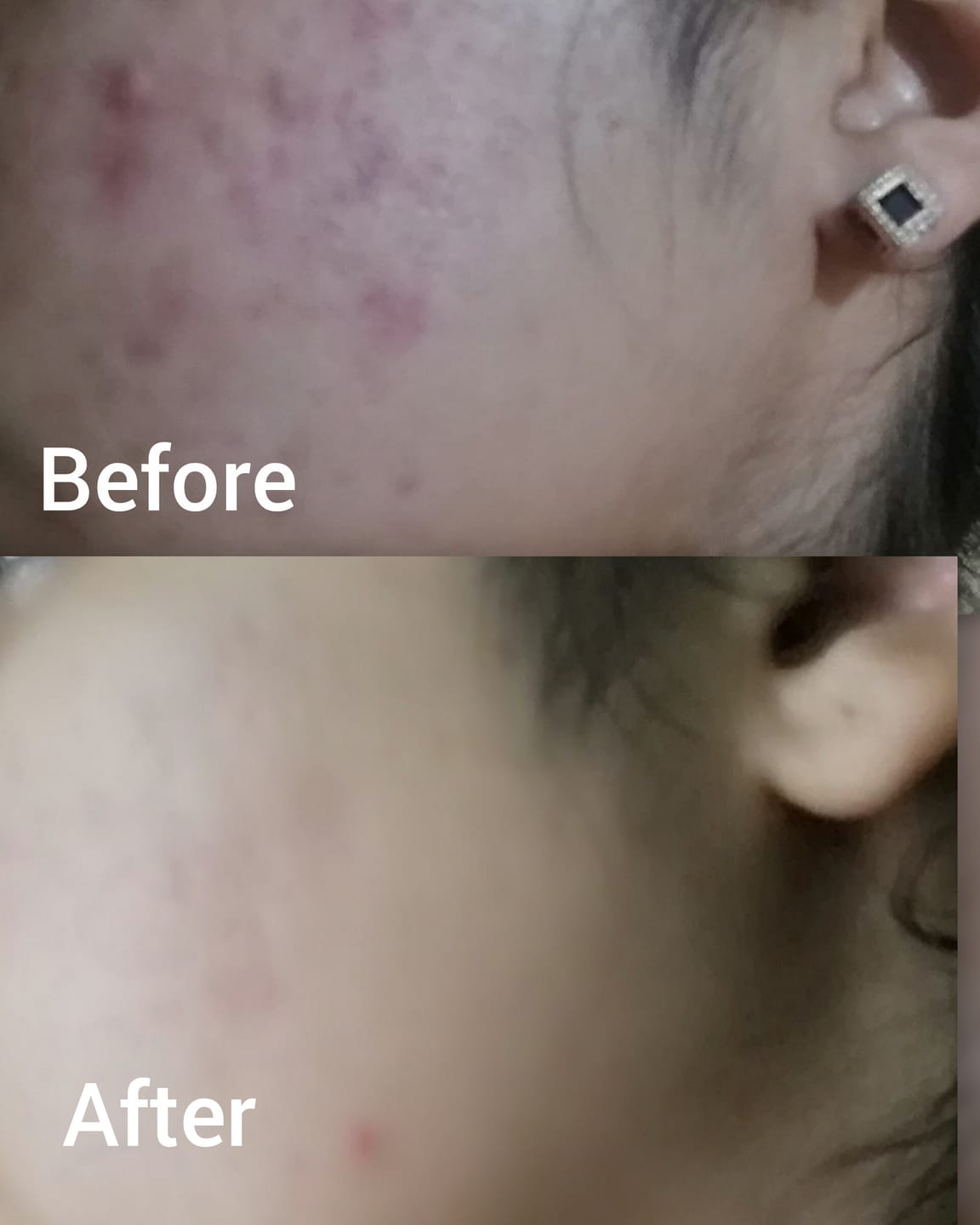 Customer photo review of MandelAC Serum