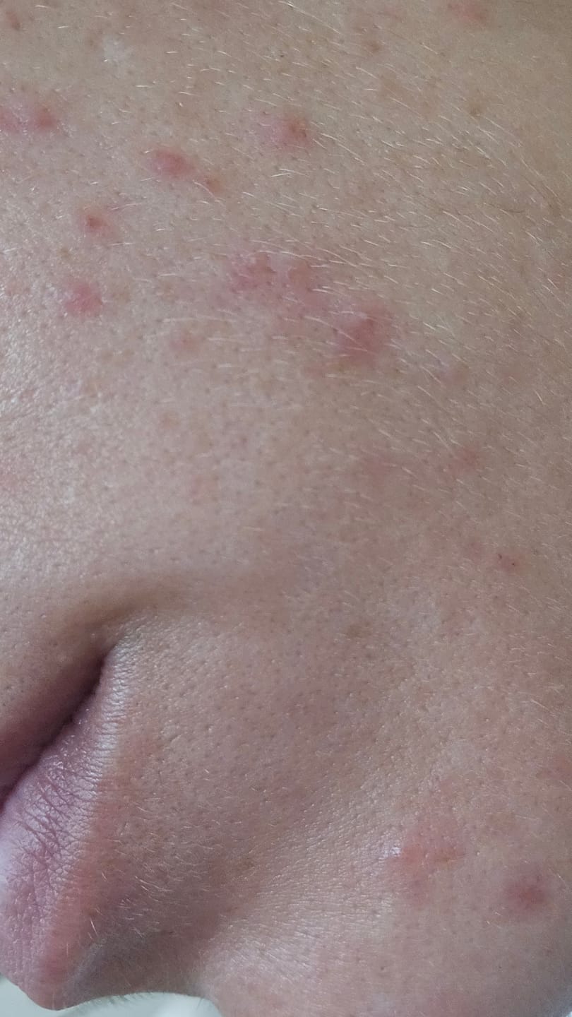 Customer photo review of MIRACLE H -  ÁCIDO HIPOCLOROSO - TÓNICO ANTIBACTERIANO Y ANTIINFLAMATORIO
