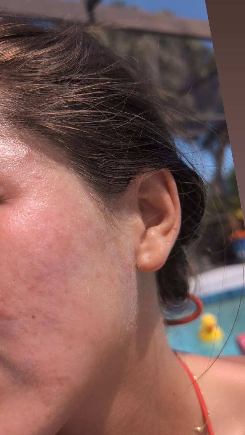 Customer photo review of Kill Acne & Redness Ritual