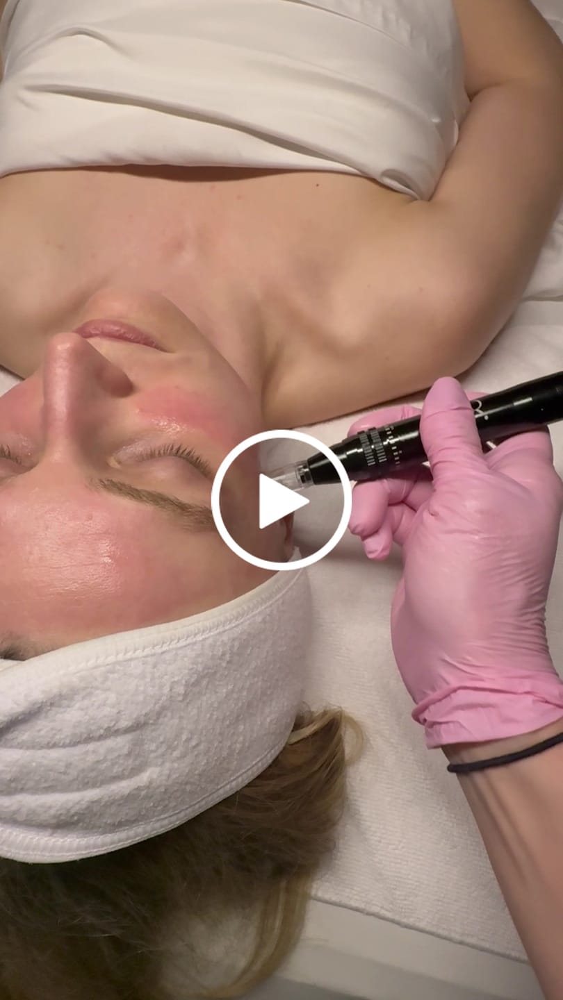Customer video review of Reset Skin System Dermal Needling Device