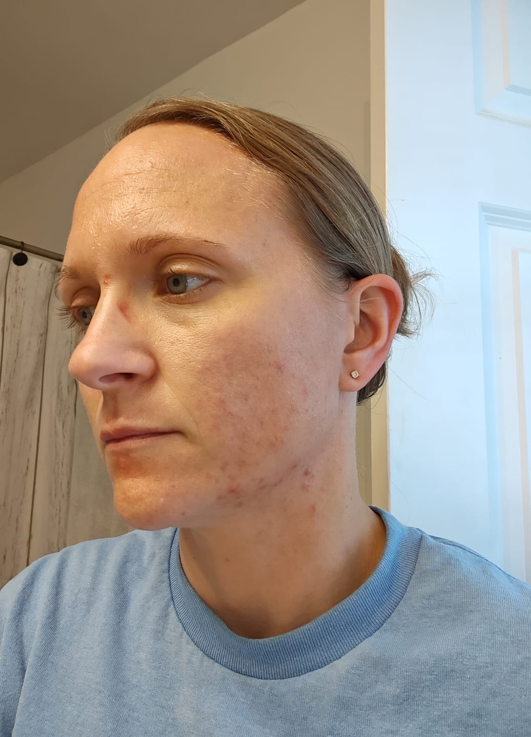 Customer photo review of Kill Acne & Redness Ritual