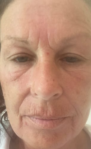 Customer's face showing wrinkles and fine lines before using the Glov Micro Infusion System.