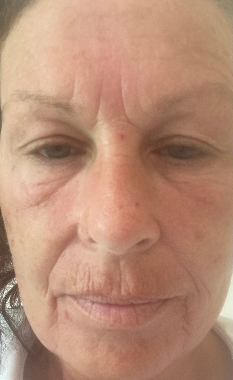 Customer photo review of Glov Micro Infusion System