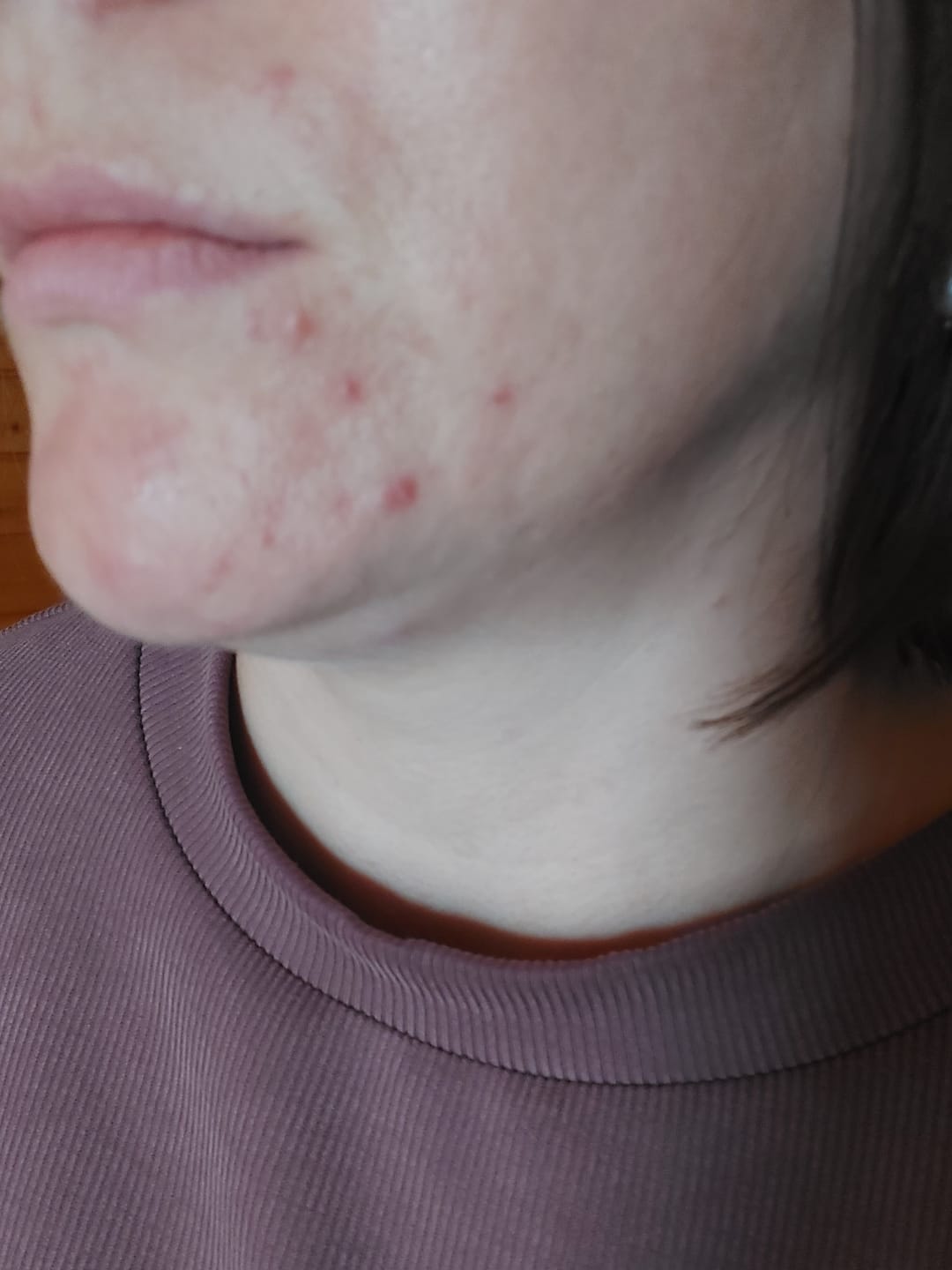 Customer photo review of TuumBiome Pattanás Elleni Gél Fágtechnológiával