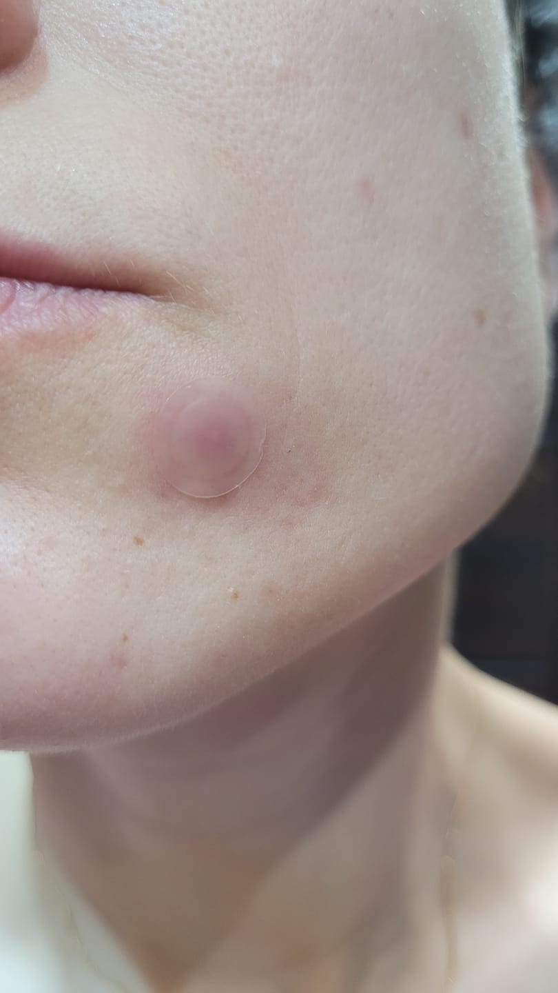 Customer photo review of Patči pret pinnēm Cosrx Acne Pimple Master Patch