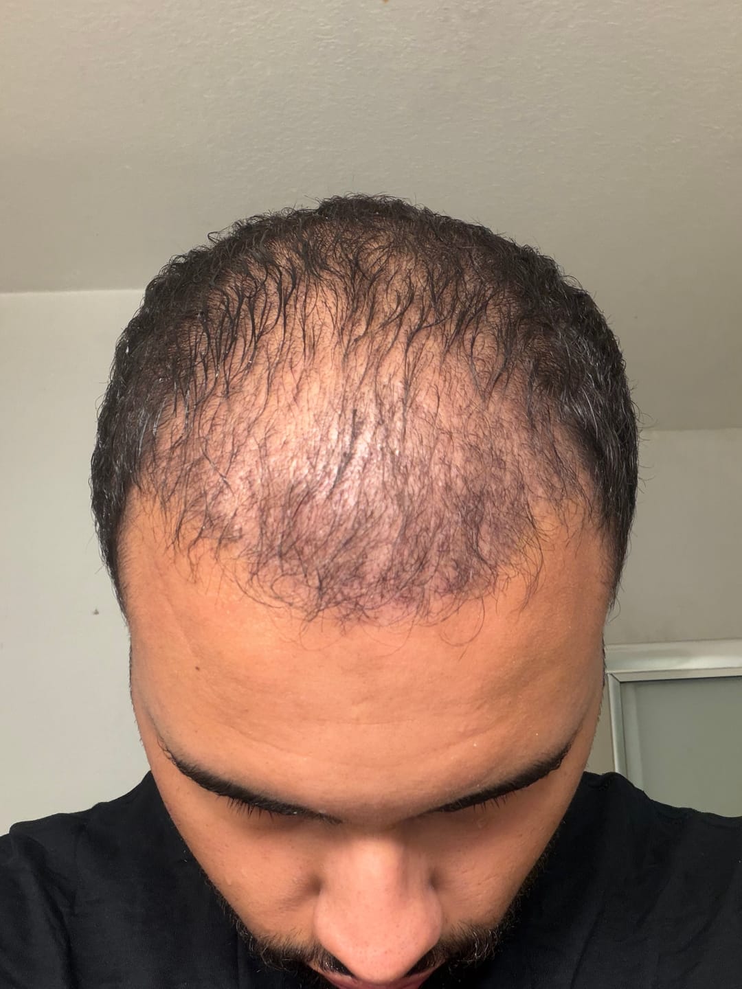 Customer photo review of Premium Hair Thickening Fibers
