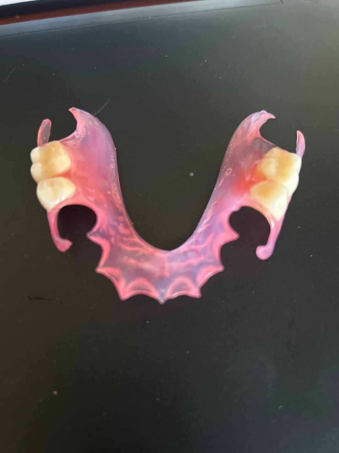 Customer photo review of Clear Flexible Partial Denture