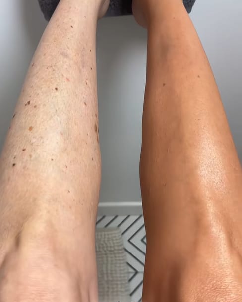 Customer photo review of SkinVeil | Körper Make-up