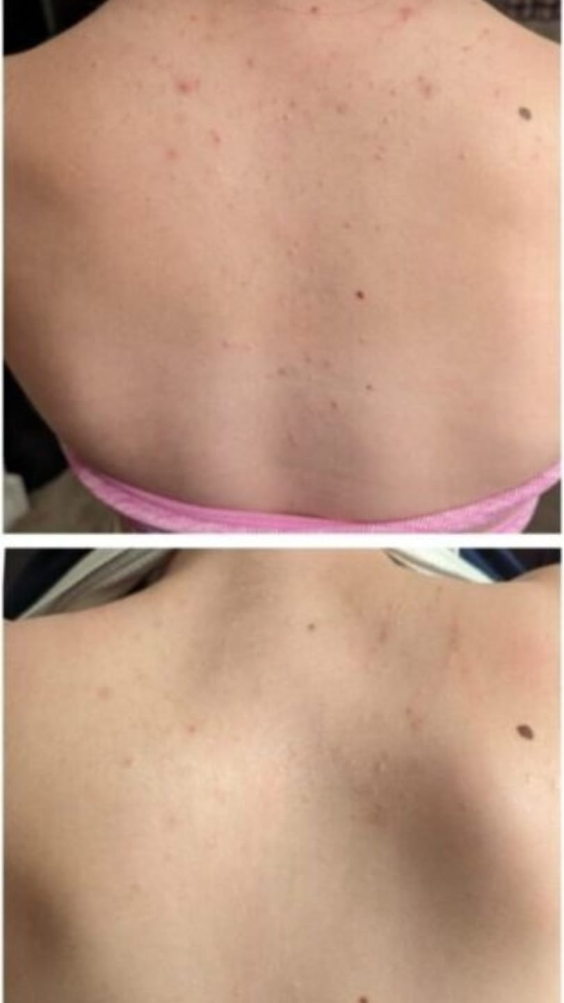 Customer photo review of Barra Antiacné™
