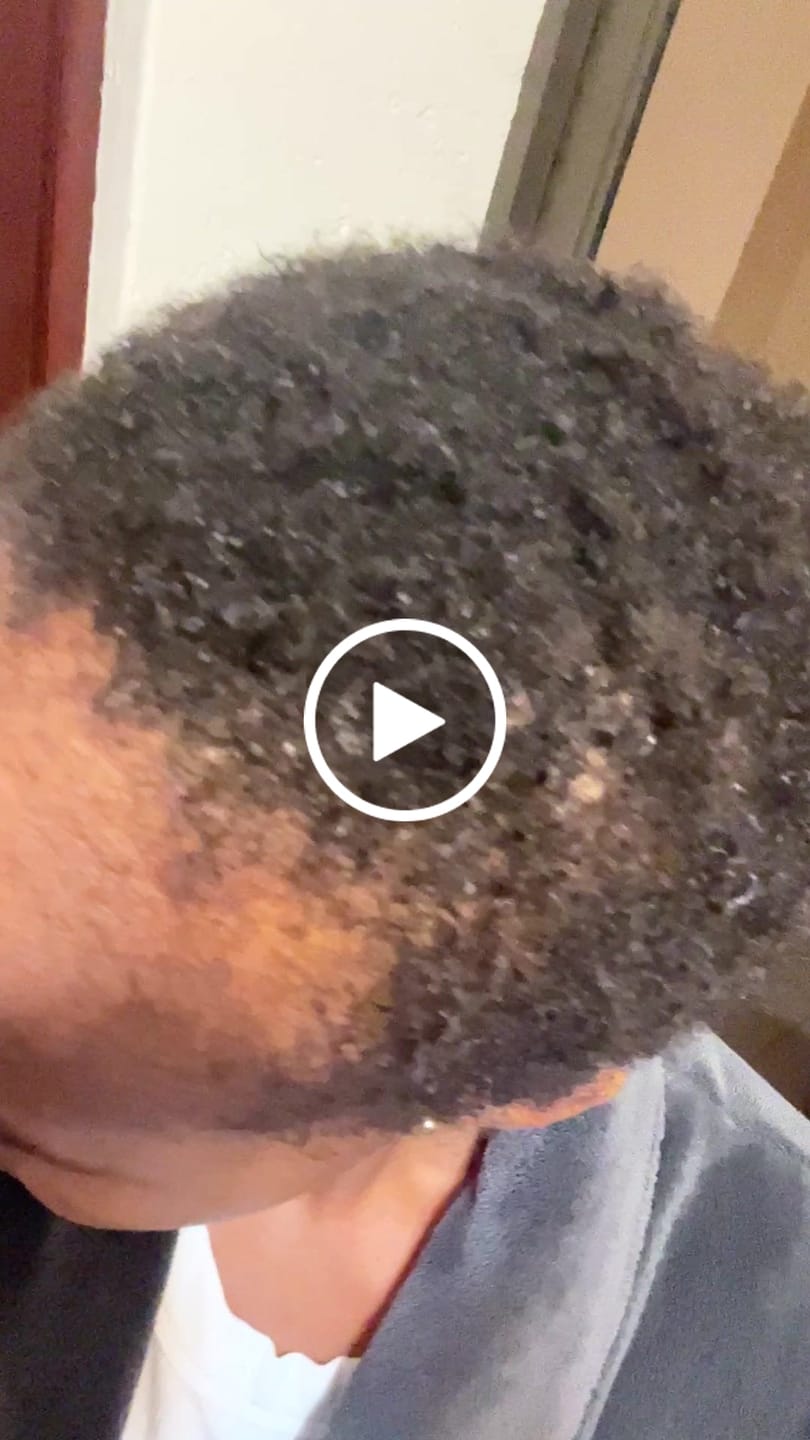 Customer video review of Hair & Hairline Growth Serum Set