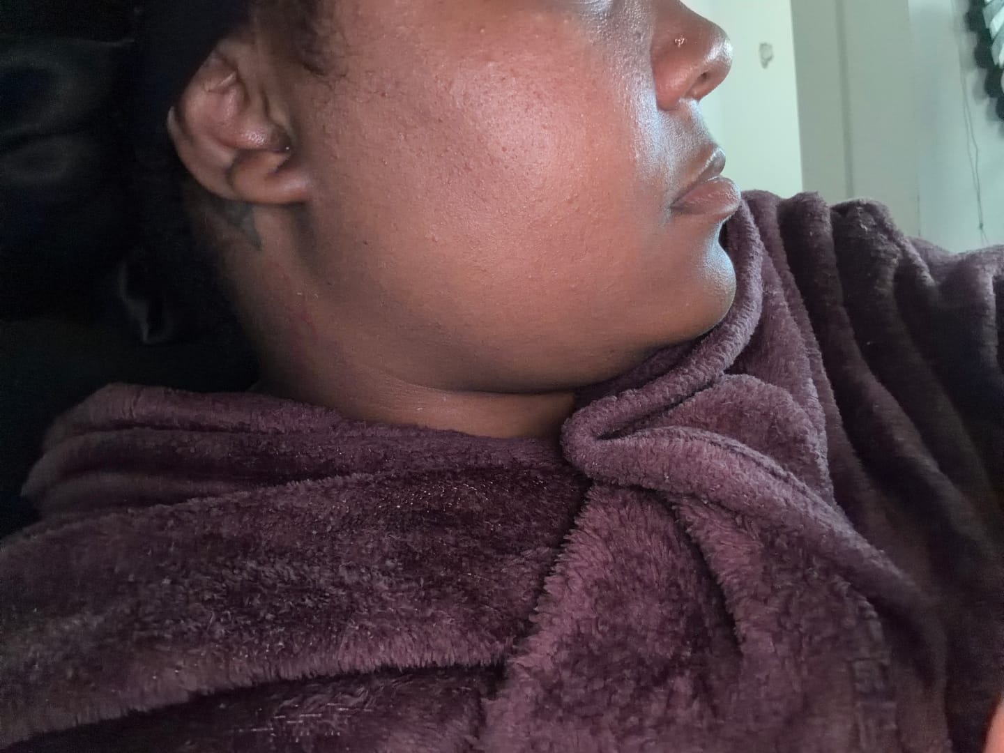 Customer photo review of LIMITED EDITION: Jolie’s Mini Full Body & Face Brightening Kit/ Acne Kit