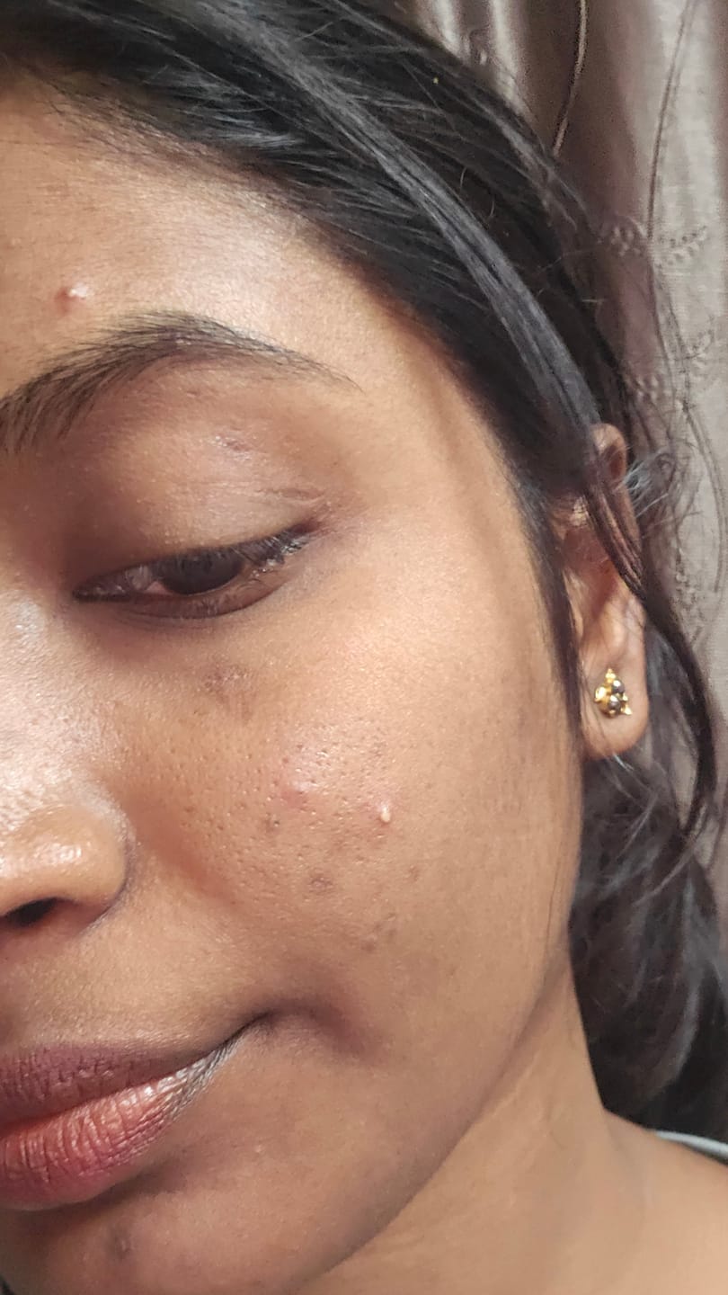 Customer photo review of Carrot Therapy Multi Correct Cream