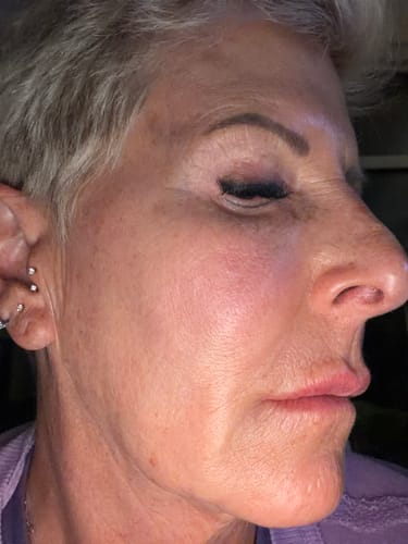 Reviewer's close-up profile showing their facial skin after using the Seranova Microneedling Infusion System.