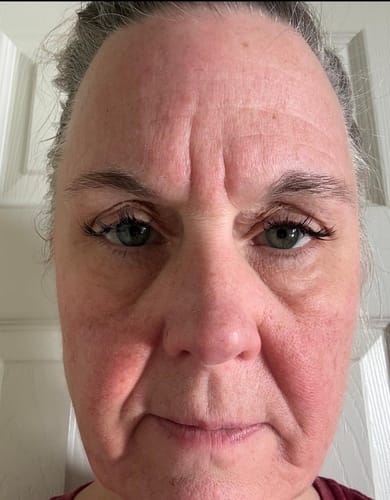 Reviewer's face before using The Micro Infusion System, showing fine lines and visible skin redness.