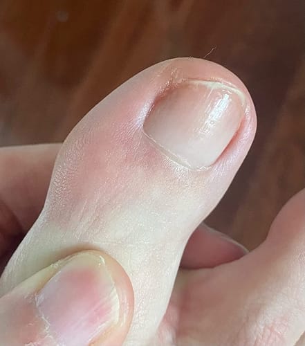 Customer photo review of MyCurePro® · Clears Foot & Hand Fungus · 7 Days