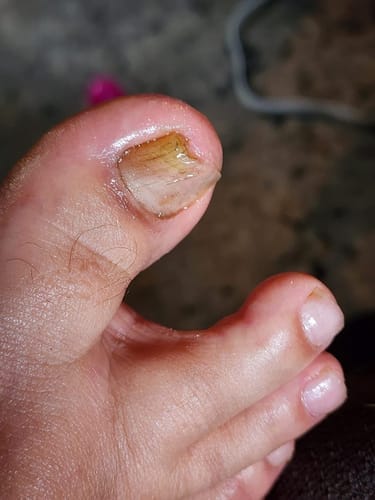 Customer photo review of MyCurePro® · Clears Foot & Hand Fungus · 7 Days