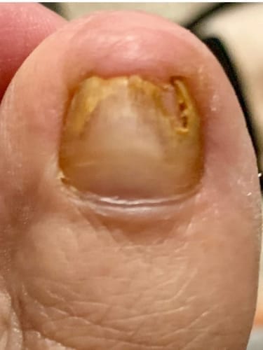 Customer photo review of MyCurePro® · Clears Foot & Hand Fungus · 7 Days