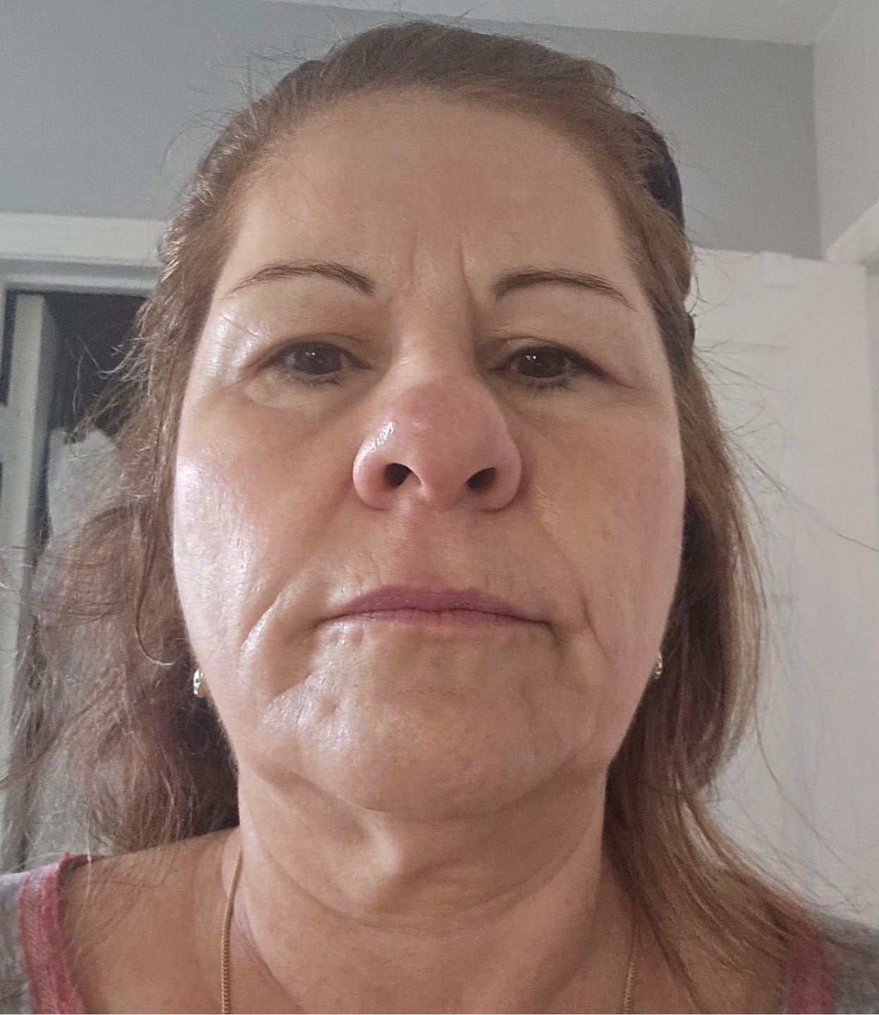 Customer photo review of EvenSkyn® Lumo⁺: Premium Anti-Aging & Skin Tightening Handset (2025)