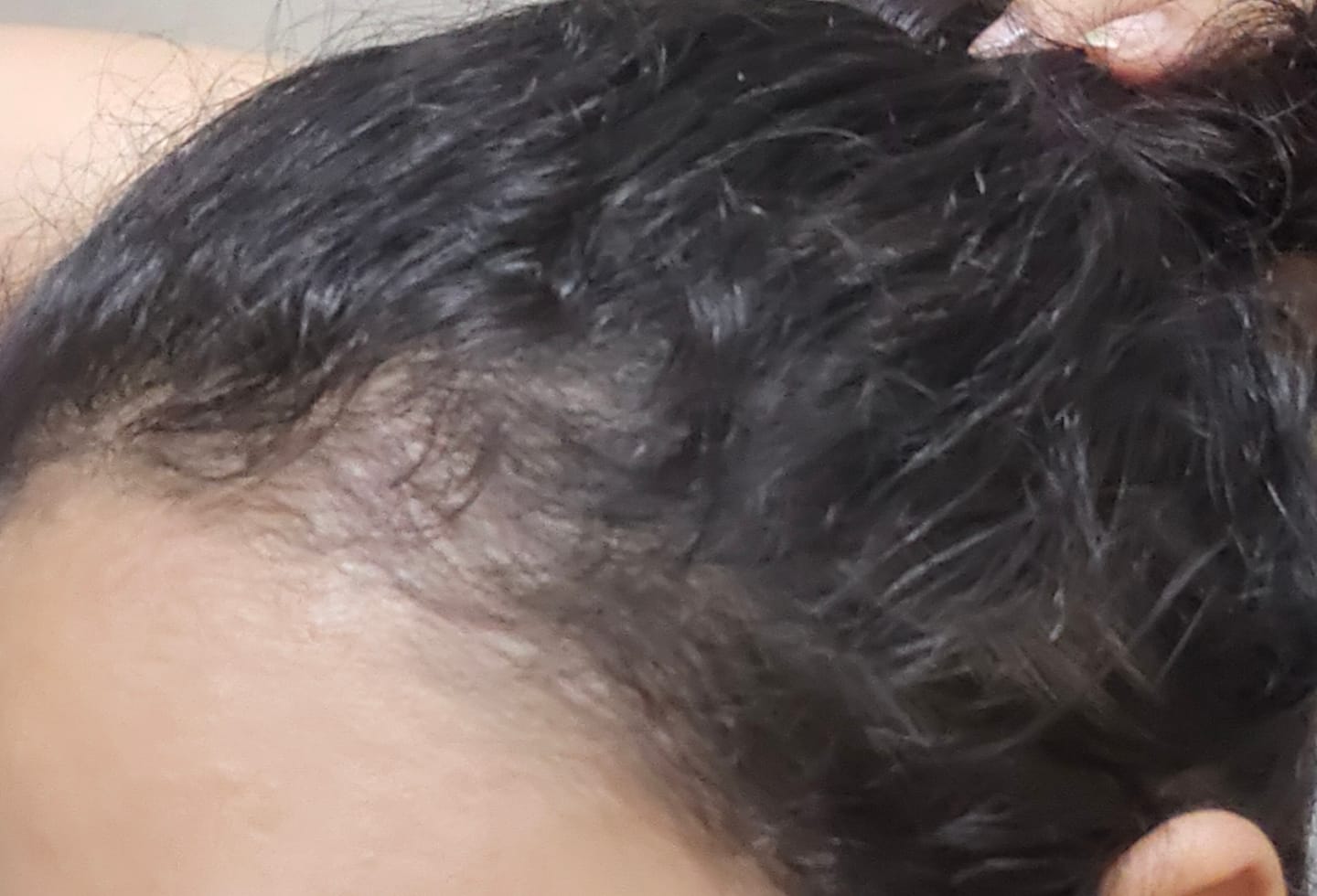 Customer photo review of Follicle Booster Ampoules (Intense Rescue Shots)
