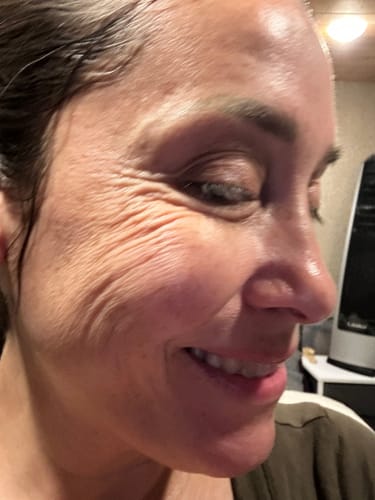 Close-up of a reviewer's eye area before using the Seranova system, showing prominent wrinkles while smiling.