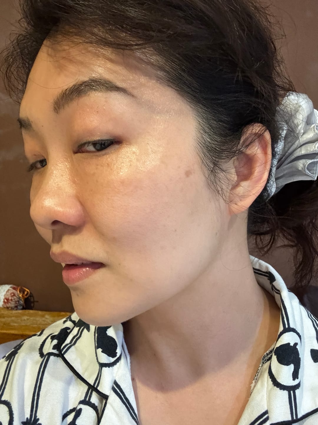 Customer photo review of Ventamin Light Up: Doctor-Formulated Brightening Formula for Melasma, Acne scars & Hyperpigmentation