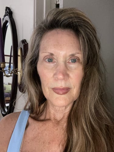 Reviewer's face after one month of treatment with the Seranova Micro Infusion System.