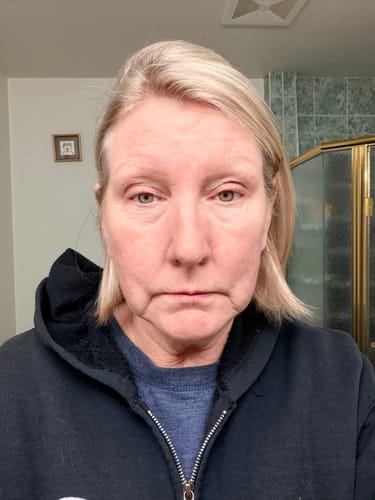 Reviewer's face before using the Seranova Micro Infusion System, showing her skin texture.