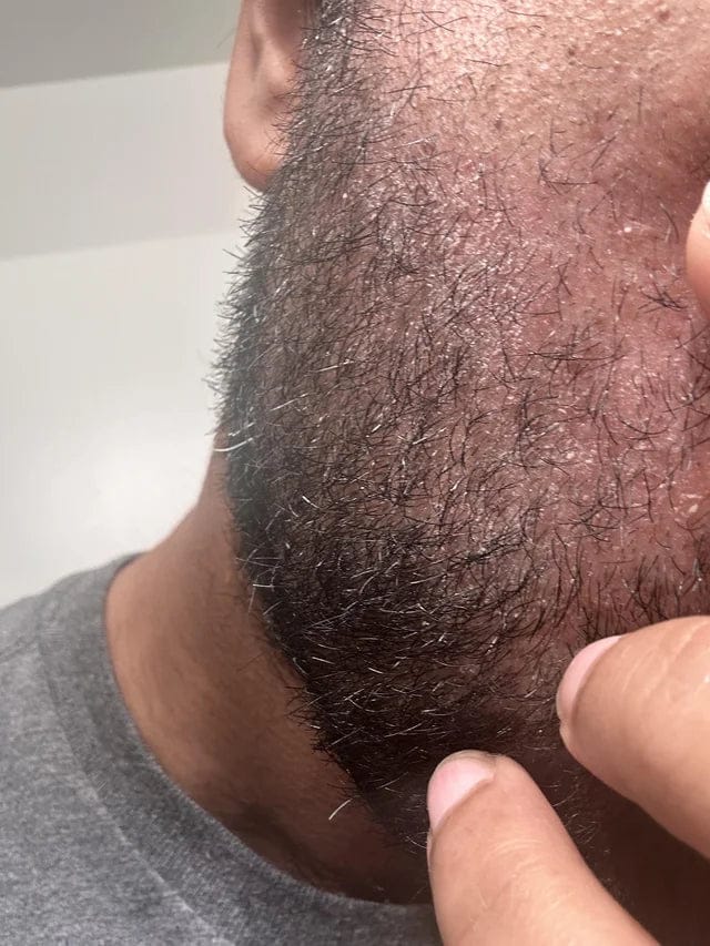 Customer photo review of Flyleaf®  Visible Beard & Scalp Relief in 7 Days Without Steroids