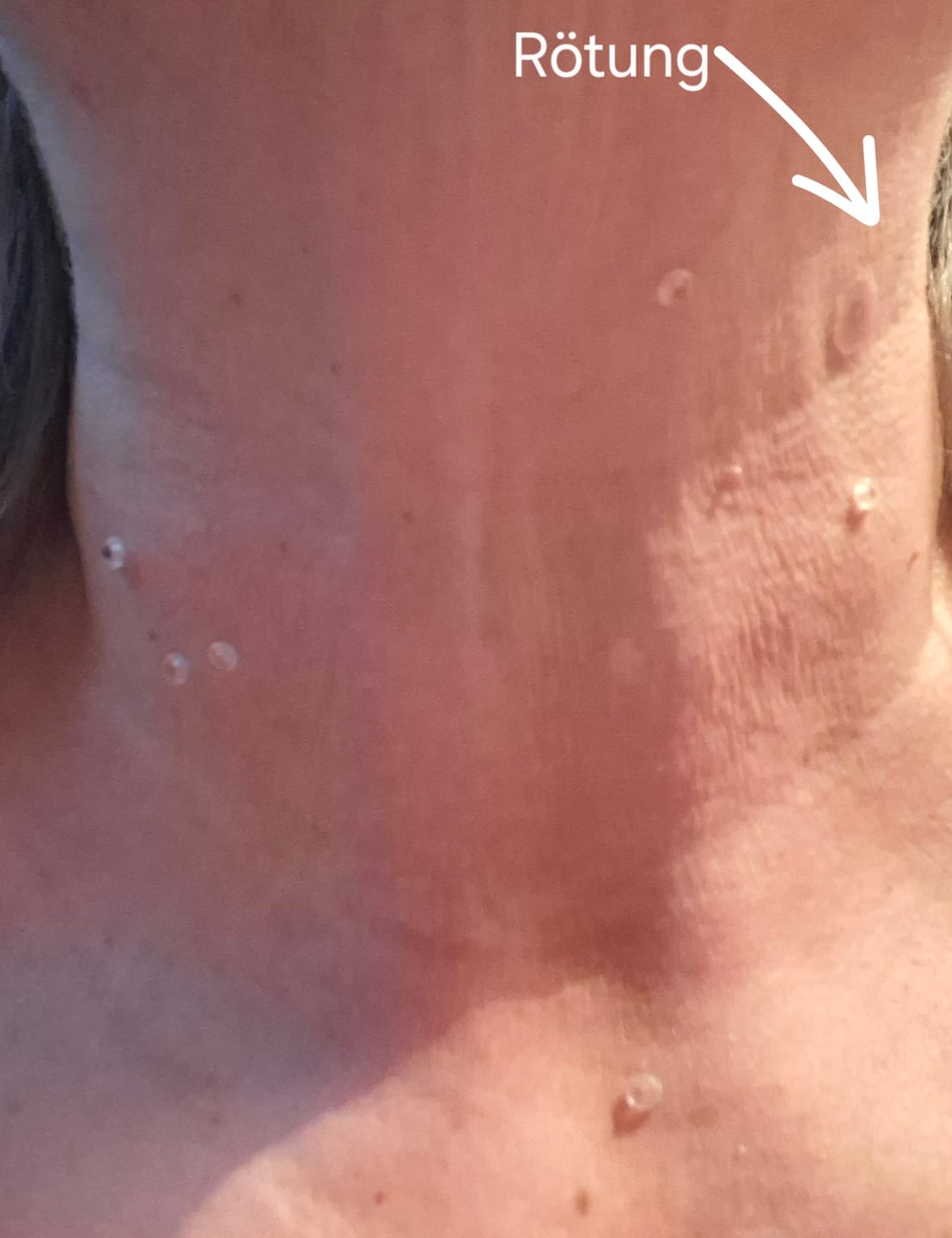 Customer photo review of Alcura Aftercare Patches