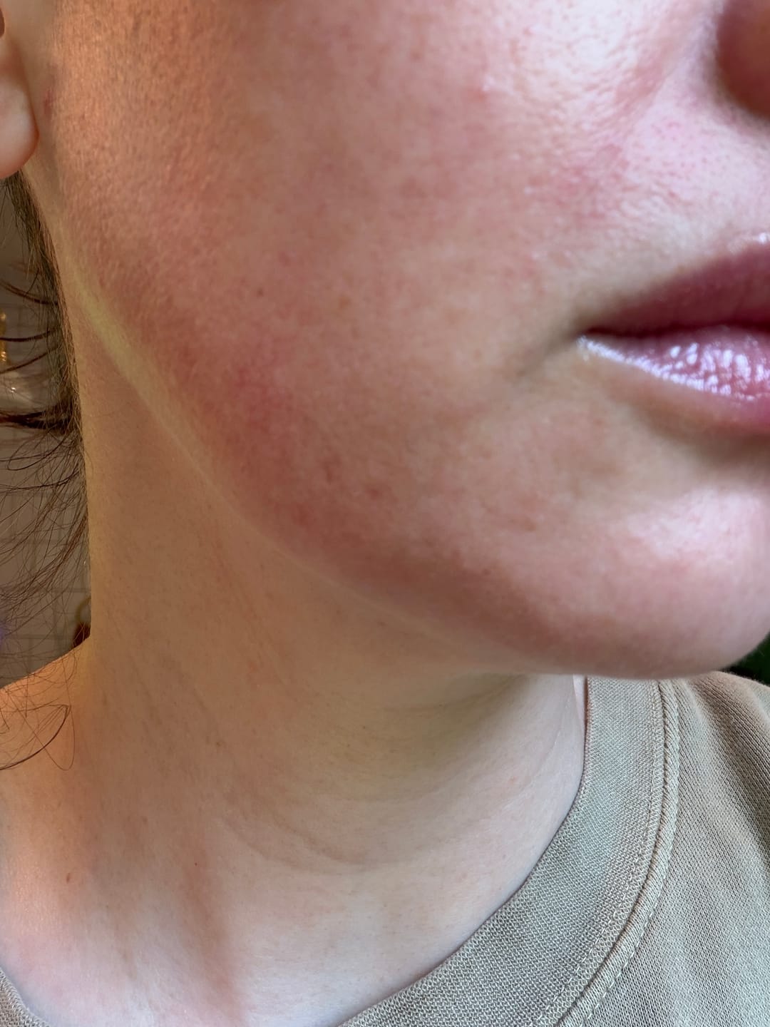 Customer photo review of The Complete Acne System for Women