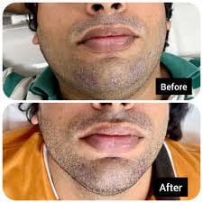 Customer photo review of Flyleaf®  Visible Beard & Scalp Relief in 7 Days Without Steroids