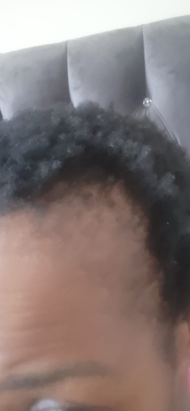 Customer photo review of New Formula: Scalp Serum Set