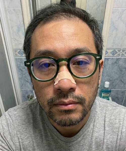 Customer photo review of nordicalm™ Nasal Strips for Sleep