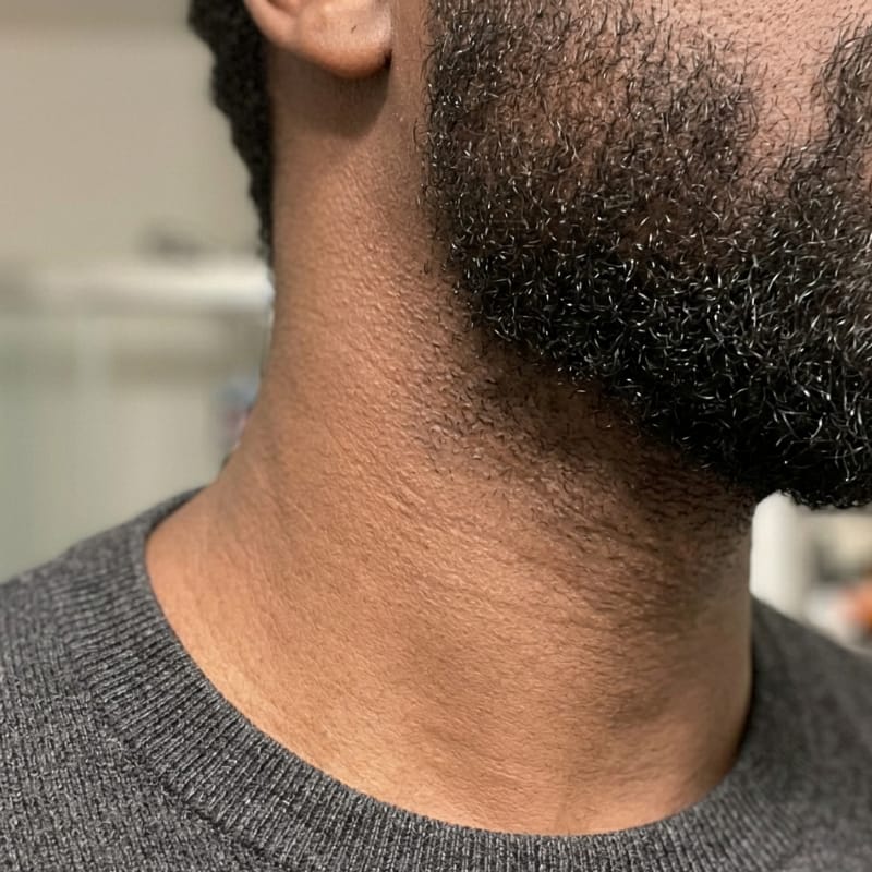 Customer photo review of Flyleaf®  Visible Beard & Scalp Relief in 7 Days Without Steroids