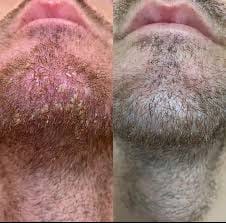 Customer photo review of Flyleaf®  Visible Beard & Scalp Relief in 7 Days Without Steroids