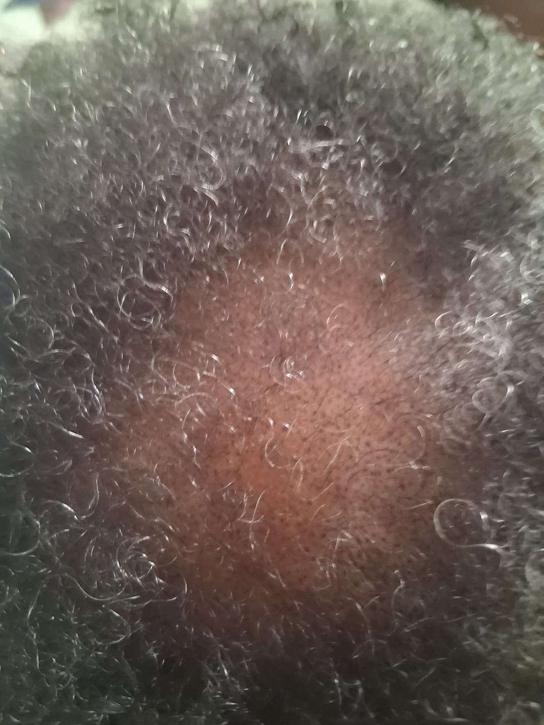 Customer photo review of SPECIAL OFFER: Three Bottles of Rennora Hair Growth Serum