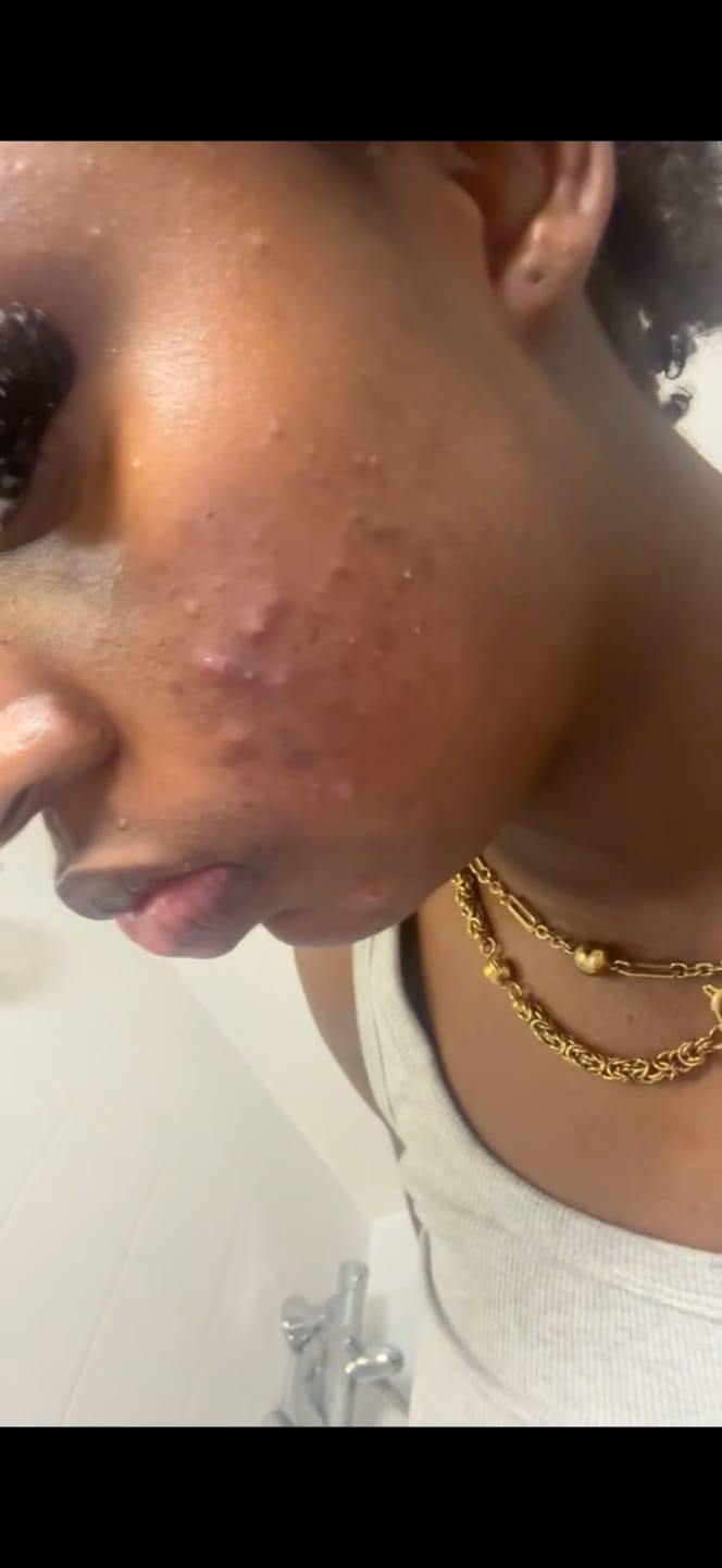 Customer photo review of Glow Wash Salicylic Acid + Sulphur  Facial Cleanser