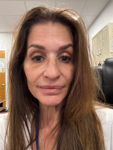 Reviewer's close-up photo showing her facial skin while using the Seranova Micro Infusion System.