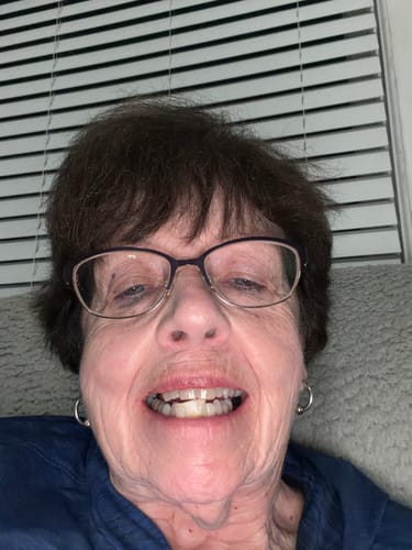 Customer photo review of Imako® Tooth Tinted Plastic – Temporary Tooth – For Chipped Tooth & Fill Gaps in Teeth